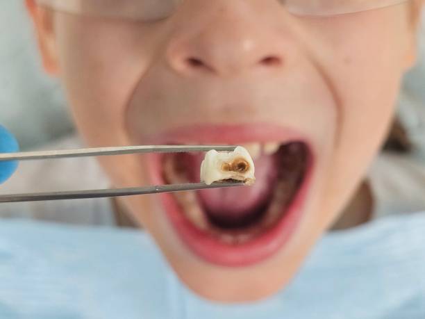 Best Knocked-Out Tooth (Avulsed Tooth) Treatment in Bridgeport, TX